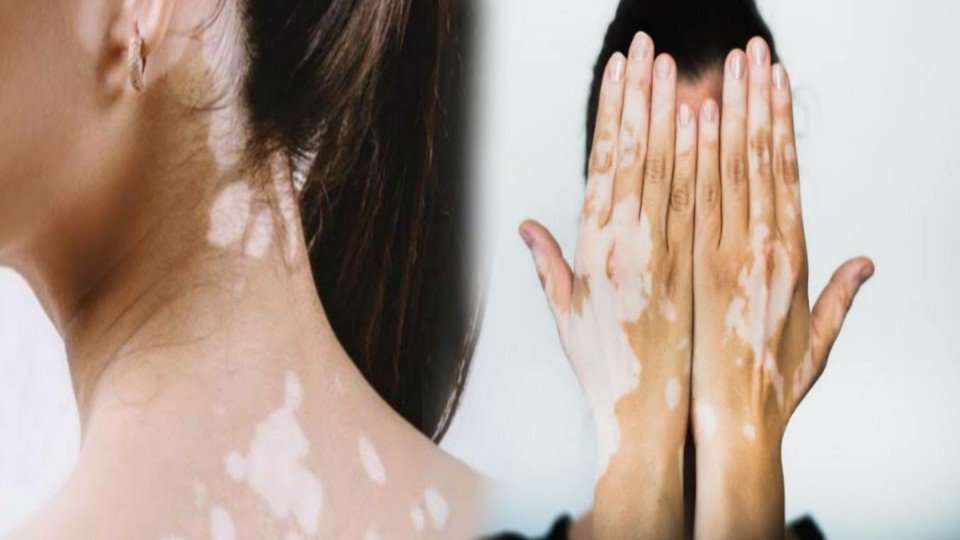 पांढरे डाग कोड